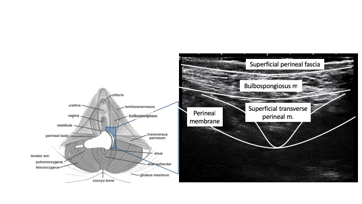 pelvic floor dysfunction in dancers